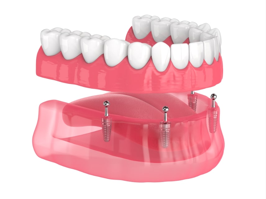 Image of implant dentures